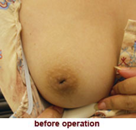 plastic_surgery_inverted_nipple_correction_1_1