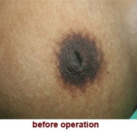 plastic_surgery_inverted_nipple_correction_2_1