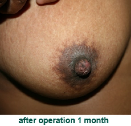 plastic_surgery_inverted_nipple_correction_2_2